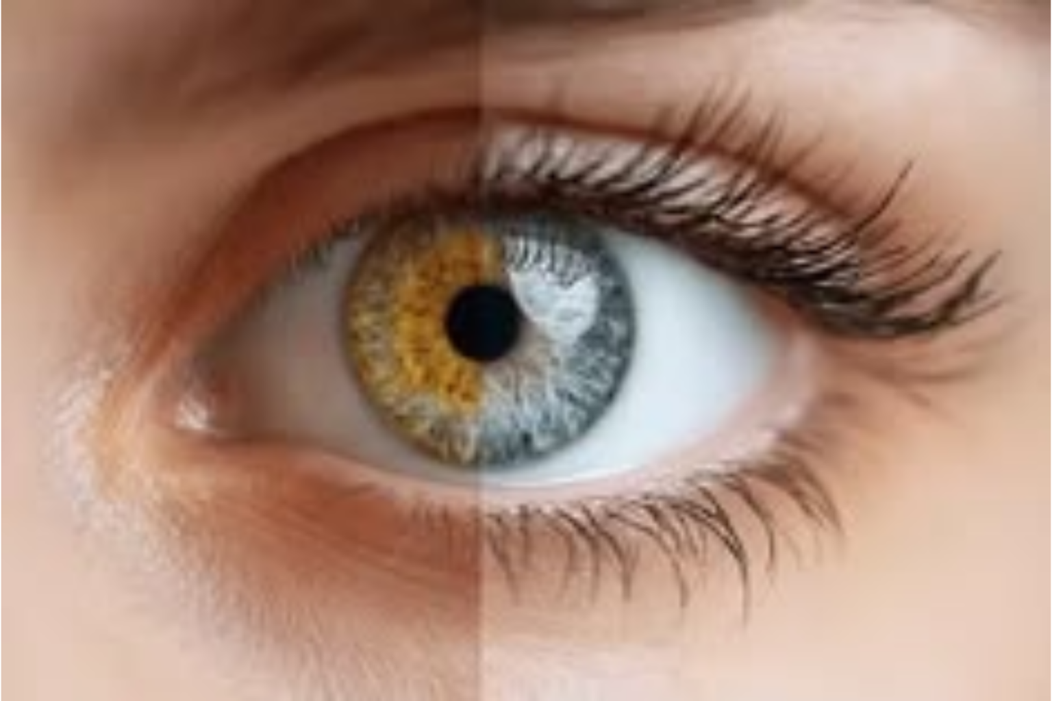 cataract surgery